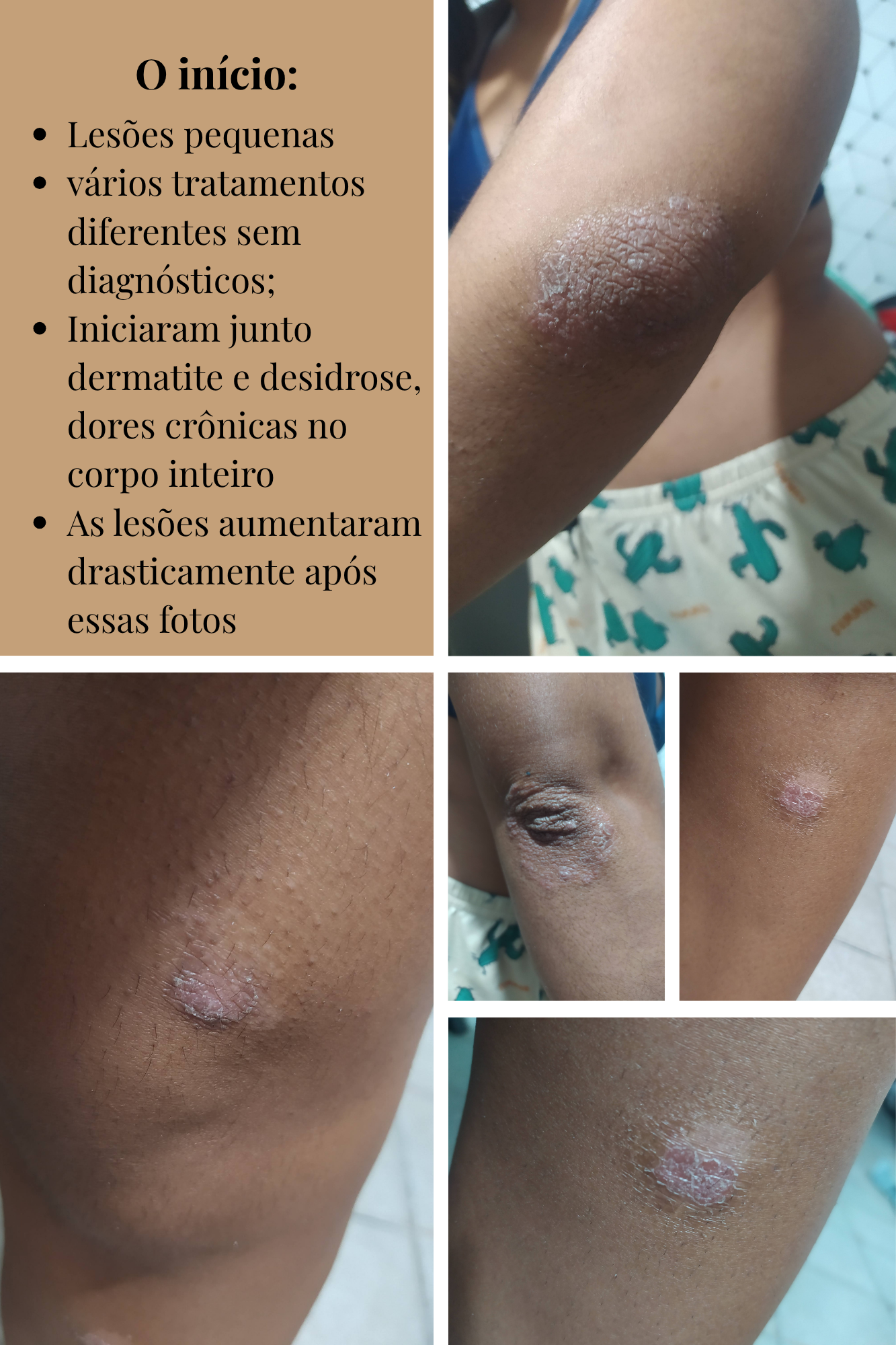 O início: lesões pequenas e vários tratamentos sem diagnóstico
